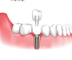 Top Dental Implant Brands: Comparing Quality, Innovation, and Trust in Modern Dentistry