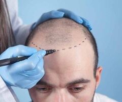 Affordable Hair Transplant in Mumbai - Best Surgeon