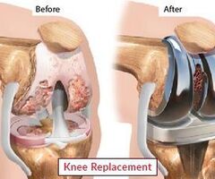 Affordable and Advanced Knee Replacement Surgery in India|Edhacare