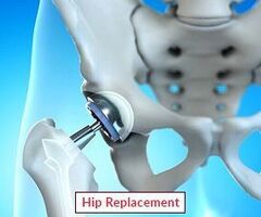 Low-Cost Hip Replacement Surgery in India | Expert Support by EdhaCare