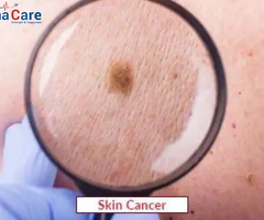 Affordable & Advanced Skin Cancer Treatment in India – Book Your Appointment Today