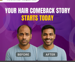Best Hair Transplant Clinic – Get Your Hair Comeback Today