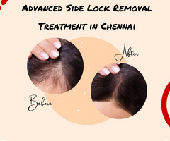 Advanced Side Lock Hair Removal Treatment in Chennai