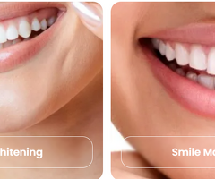 Dental Treatments in Chandigarh | Complete Dental Care at Dentlux - 2