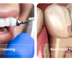 Dental Treatments in Chandigarh | Complete Dental Care at Dentlux - 3