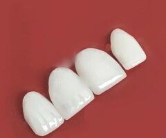 Dental Veneer Treatment in Chandigarh | Improve Your Smile with Veneers