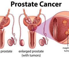 Prostate Cancer Treatment in Kolkata – Take the Right Step Early