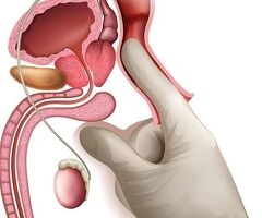 Prostate Cancer Treatment in Kolkata – Take the Right Step Early - 3