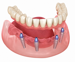 Advanced Implants for Missing Teeth in Pune by Dr. Hileri Mori